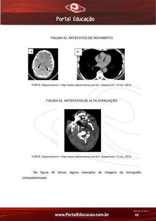 AN02FREV001/REV 4.0
68
FIGURA 42. ARTEFATOS DE MOVIMENTO
FONTE: Disponível em: <http://www.radioinmama.com.br>. Acesso em: 13 nov. 2012.
FIGURA 43. ARTEFATOS DE ALTA ATENUAÇÃO
FONTE: Disponível em: <http://www.radioinmama.com.br>. Acesso em: 13 nov. 2012.
Na figura 44 temos alguns exemplos de imagens de tomografia
computadorizada.
A B
 