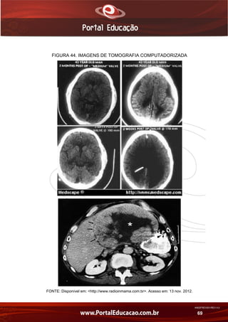 AN02FREV001/REV 4.0
69
FIGURA 44. IMAGENS DE TOMOGRAFIA COMPUTADORIZADA
FONTE: Disponível em: <http://www.radioinmama.com.br>. Acesso em: 13 nov. 2012.
 