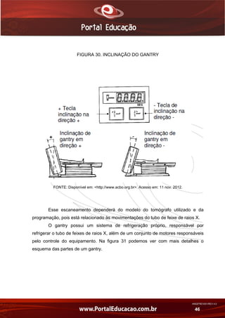AN02FREV001/REV 4.0
46
FIGURA 30. INCLINAÇÃO DO GANTRY
FONTE: Disponível em: <http://www.acbo.org.br>. Acesso em: 11 nov. 2012.
Esse escaneamento dependerá do modelo do tomógrafo utilizado e da
programação, pois está relacionado às movimentações do tubo de feixe de raios X.
O gantry possui um sistema de refrigeração próprio, responsável por
refrigerar o tubo de feixes de raios X, além de um conjunto de motores responsáveis
pelo controle do equipamento. Na figura 31 podemos ver com mais detalhes o
esquema das partes de um gantry.
 