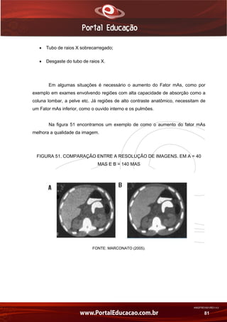 AN02FREV001/REV 4.0
81
 Tubo de raios X sobrecarregado;
 Desgaste do tubo de raios X.
Em algumas situações é necessário o aumento do Fator mAs, como por
exemplo em exames envolvendo regiões com alta capacidade de absorção como a
coluna lombar, a pelve etc. Já regiões de alto contraste anatômico, necessitam de
um Fator mAs inferior, como o ouvido interno e os pulmões.
Na figura 51 encontramos um exemplo de como o aumento do fator mAs
melhora a qualidade da imagem.
FIGURA 51. COMPARAÇÃO ENTRE A RESOLUÇÃO DE IMAGENS. EM A = 40
MAS E B = 140 MAS
FONTE: MARCONATO (2005).
 