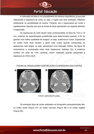 AN02FREV001/REV 4.0
74
A colimação do feixe é um procedimento de extrema importância, já que está
relacionada à espessura do corte, ou seja, à região que será analisada, refletindo
diretamente na sensibilidade do exame. Portanto, ela é responsável por evitar o
espalhamento, fazendo com que as linhas do feixe apresentem um aspecto alinhado
e organizado.
As espessuras de corte devem estar compreendidas na faixa de 1mm a 10
mm, podendo ter especificações predefinidas para determinados exames, a fim de
garantir uma melhor qualidade da imagem, ou seja, ausência de ruídos. Espessuras
de cortes muito finas tendem a gerar mais ruídos quando comparadas às
espessuras mais largas, ou seja, apresentam uma resolução inferior. Na figura 46
encontramos a comparação entre duas espessuras distintas. Em A podemos
verificar um corte de 1mm, portanto, menor resolução quando comparada à
espessura de 10mm de B.
FIGURA 46. RESOLUÇÕES COM RELAÇÃO À ESPESSURA DOS CORTES
FONTE: MARCONATO (2005).
Os principais tipos de cortes realizados na tomografia computadorizada são:
os cortes axiais (Figura 47), os cortes coronais (Figura 48) e os cortes sagitais
(Figura 49).
 