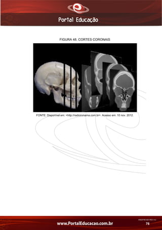 AN02FREV001/REV 4.0
76
FIGURA 48. CORTES CORONAIS
FONTE: Disponível em: <http://radioinmama.com.br>. Acesso em: 10 nov. 2012.
 