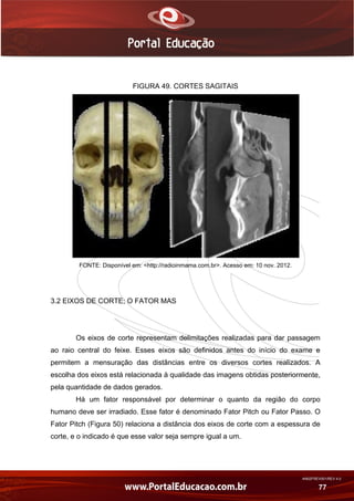 AN02FREV001/REV 4.0
77
FIGURA 49. CORTES SAGITAIS
FONTE: Disponível em: <http://radioinmama.com.br>. Acesso em: 10 nov. 2012.
3.2 EIXOS DE CORTE; O FATOR MAS
Os eixos de corte representam delimitações realizadas para dar passagem
ao raio central do feixe. Esses eixos são definidos antes do início do exame e
permitem a mensuração das distâncias entre os diversos cortes realizados. A
escolha dos eixos está relacionada à qualidade das imagens obtidas posteriormente,
pela quantidade de dados gerados.
Há um fator responsável por determinar o quanto da região do corpo
humano deve ser irradiado. Esse fator é denominado Fator Pitch ou Fator Passo. O
Fator Pitch (Figura 50) relaciona a distância dos eixos de corte com a espessura de
corte, e o indicado é que esse valor seja sempre igual a um.
 