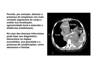 Permite, por exemplo, detectar a
presença de neoplasias nos mais
variados segmentos do corpo e
avaliar sua localização,
agressividade local e extensão a
distâncias (metástases).

No caso das doenças infecciosas
pode fazer seu diagnóstico,
demonstrar os órgãos
acometidos, sua gravidade e a
presença de complicações, como
abscessos e fístulas.
 