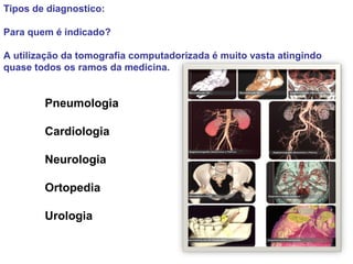 Tipos de diagnostico:

Para quem é indicado?

A utilização da tomografia computadorizada é muito vasta atingindo
quase todos os ramos da medicina.


        Pneumologia

        Cardiologia

        Neurologia

        Ortopedia

        Urologia
 
