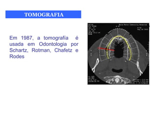 TOMOGRAFIA



Em 1987, a tomografía é
usada em Odontologia por
Schartz, Rotman, Chafetz e
Rodes
 