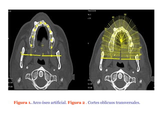Figura 1. Arco óseo artificial. Figura 2 . Cortes oblicuos transversales.
 