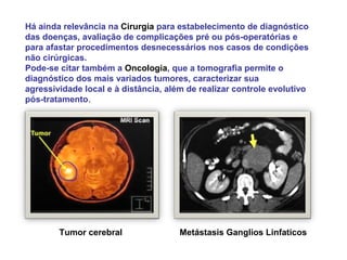 Há ainda relevância na Cirurgia para estabelecimento de diagnóstico
das doenças, avaliação de complicações pré ou pós-operatórias e
para afastar procedimentos desnecessários nos casos de condições
não cirúrgicas.
Pode-se citar também a Oncologia, que a tomografia permite o
diagnóstico dos mais variados tumores, caracterizar sua
agressividade local e à distância, além de realizar controle evolutivo
pós-tratamento.




        Tumor cerebral                Metástasis Ganglios Linfaticos
 
