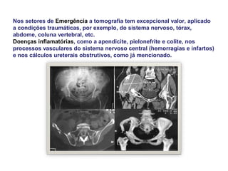 Nos setores de Emergência a tomografia tem excepcional valor, aplicado
a condições traumáticas, por exemplo, do sistema nervoso, tórax,
abdome, coluna vertebral, etc.
Doenças inflamatórias, como a apendicite, pielonefrite e colite, nos
processos vasculares do sistema nervoso central (hemorragias e infartos)
e nos cálculos ureterais obstrutivos, como já mencionado.
 