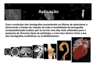 Aplicação

Com a evolução dos tomógrafos aumentando as fileiras de detectores e
diminuindo o tempo de rotação do tubo a modalidade de tomografia
computadorizada acabou por se tornar uma das mais utilizadas para a
pesquisa de diversos tipos de patologia, e com isso damos início a era
dos tomógrafos multislices ou multidetectores.
 