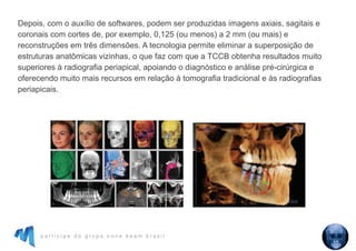p a r t i c i p e d o g r u p o c o n e b e a m b r a s i l
Depois, com o auxílio de softwares, podem ser produzidas imagens axiais, sagitais e
coronais com cortes de, por exemplo, 0,125 (ou menos) a 2 mm (ou mais) e
reconstruções em três dimensões. A tecnologia permite eliminar a superposição de
estruturas anatômicas vizinhas, o que faz com que a TCCB obtenha resultados muito
superiores à radiografia periapical, apoiando o diagnóstico e análise pré-cirúrgica e
oferecendo muito mais recursos em relação à tomografia tradicional e às radiografias
periapicais.
 