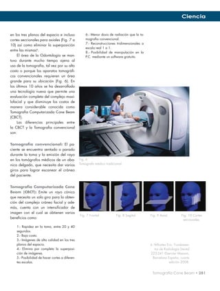 Ciencia


en los tres planos del espacio e incluso             6.- Menor dosis de radiación que la to-
cortes seccionales para axiales (Fig. 7 a            mografía convencional.
                                                     7.- Reconstrucciones tridimensionales a
10) así como eliminar la superposición
                                                     escala real 1 a 1.
entre las mismas6.
                                                     8.- Posibilidad de manipulación en la
    El área de la Odontología se man-                P.C. mediante un software gratuito.
tuvo durante mucho tiempo ajena al
uso de la tomografía, tal vez por su alto
costo o porque los aparatos tomográfi-
cos convencionales requieren un área
grande para su ubicación (Fig. 6). En
los últimos 10 años se ha desarrollado
una tecnología nueva que permite una
evaluación completa del complejo maxi-
lofacial y que disminuye los costos de
manera considerable conocida como
Tomografía Computarizada Cone Beam
(CBCT).
    Las diferencias principales entre
la CBCT y la Tomografía convencional
son:


Tomografía convencional: El pa-
ciente se encuentra sentado o parado
durante la toma y la emisión del rayo
en los tomógrafos médicos de un aba-             Fig. 6
nico delgado, que necesita dar varios            Tomógrafo médico tradicional.

giros para lograr escanear el cráneo
del paciente.


Tomografía Computarizada Cone
Beam (CBCT): Emite un rayo cónico
que necesita un solo giro para la obten-
ción del complejo cráneo facial y ade-
más, cuenta con un intensificador de
imagen con el cual se obtienen varios
                                                 Fig. 7 Frontal.	 Fig. 8 Sagital.	 Fig. 9 Axial.	                   Fig. 10 Cortes
beneficios como:                                 			                                                                 seccionales.

    1.- Rapidez en la toma, entre 20 y 40
    segundos.
    2.- Bajo costo.
    3.- Imágenes de alta calidad en los tres
    planos del espacio.                                                                        6.-Whaites Eric. Fundamen-
    4.- Elimina por completo la superposi-                                                        tos de Radiología Dental
    ción de imágenes.                                                                          223-241 Elservier Masson,
    5.- Posibilidad de hacer cortes a diferen-                                                  Barcelona España, cuarta
    tes escalas.                                                                                            edición 2008.


                                                                                                Tomografía Cone Beam • 281
 