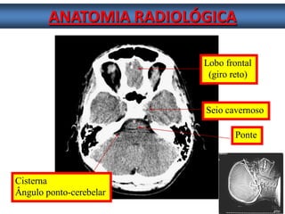 ANATOMIA RADIOLÓGICA 
Cisterna 
Ângulo ponto-cerebelar Lobo frontal (giro reto) 
Seio cavernoso 
Ponte  