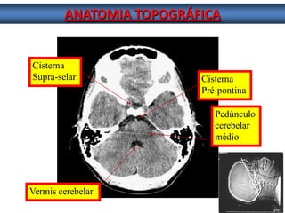 ANATOMIA TOPOGRÁFICA 
Cisterna 
Supra-selar 
Vermis cerebelar 
Pedúnculo 
cerebelar 
médio 
Cisterna 
Pré-pontina  