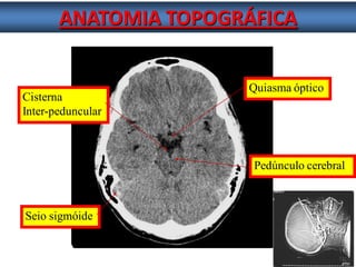 ANATOMIA TOPOGRÁFICA 
Cisterna 
Inter-peduncular 
Pedúnculo cerebral Quiasma óptico 
Seio sigmóide  