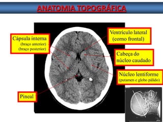 ANATOMIA TOPOGRÁFICA 
Cabeça do 
núcleo caudado Núcleo lentiforme (putamen e globo pálido) 
Cápsula interna 
(braço anterior) 
(braço posterior) 
Ventrículo lateral 
(corno frontal) 
Pineal  