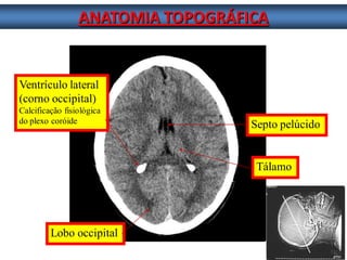 ANATOMIA TOPOGRÁFICA 
Septo pelúcido 
Tálamo 
Ventrículo lateral 
(corno occipital) 
Calcificação fisiológica 
do plexo coróide 
Lobo occipital  