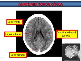 ANATOMIA TOPOGRÁFICA 
Ventrículo lateral 
(corpo) 
Lobo parietal 
Lobo frontal 
Coroa radiada  