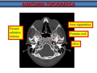 ANATOMIA TOPOGRÁFICA 
clivo 
Fissura 
orbitária 
inferior 
Arco zigomático 
Forame oval  