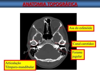 ANATOMIA TOPOGRÁFICA 
Asa do esfenóide 
Canal carotídeo 
Articulação 
Têmporo-mandibular Forame jugular  