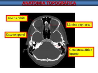 ANATOMIA TOPOGRÁFICA 
Lâmina papiracea 
Conduto auditivo 
interno 
Osso temporal 
Teto da órbita  