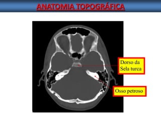 ANATOMIA TOPOGRÁFICA 
Dorso da 
Sela turca 
Osso petroso  