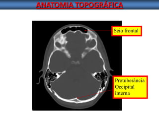 ANATOMIA TOPOGRÁFICA 
Seio frontal 
Protuberância 
Occipital 
interna  