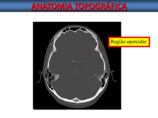 ANATOMIA TOPOGRÁFICA 
Região opercular  