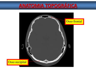 ANATOMIA TOPOGRÁFICA 
Osso frontal Osso occipital  