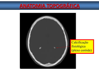 ANATOMIA TOPOGRÁFICA 
Calcificação 
fisiológica 
(plexo coróide)  