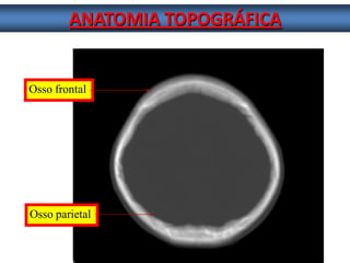 ANATOMIA TOPOGRÁFICA 
Osso frontal 
Osso parietal  