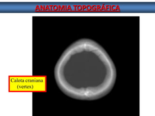 ANATOMIA TOPOGRÁFICA 
Calota craniana 
(vertex)  