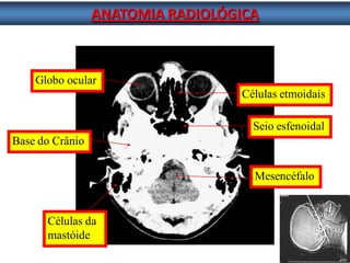 ANATOMIA RADIOLÓGICA 
Células da 
mastóide 
Seio esfenoidal Células etmoidais 
Globo ocular 
Mesencéfalo 
Base do Crânio  