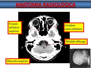ANATOMIA RADIOLÓGICA 
Músculo trapézio 
Gordura 
retro-orbitária 
Fissura 
orbitária 
superior 
Medula oblonga  