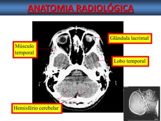ANATOMIA RADIOLÓGICA 
Glândula lacrimal 
Músculo 
temporal 
Hemisfério cerebelar 
Lobo temporal  