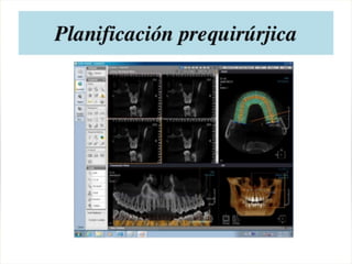 Tomografia de haz conico / Cone Beam en odontologia | PDF