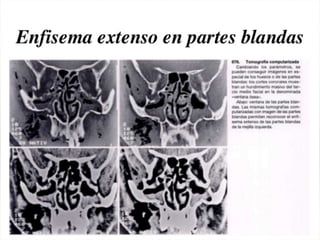 Tomografia de haz conico / Cone Beam en odontologia | PDF