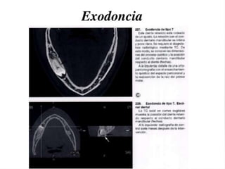 Tomografia de haz conico / Cone Beam en odontologia | PDF