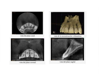 Tomografia de haz conico / Cone Beam en odontologia | PDF