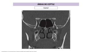Coanal
Fernando M.Biasotti, et al. Las áreas nasales de Cottle y su aplicación en tomografía, Anales de radiografía en México, 2012; 4:200-208
ÁREAS DE COTTLE
 