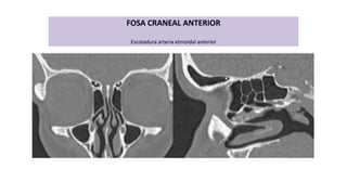 FOSA CRANEAL ANTERIOR
Escotadura arteria etmoidal anterior
 