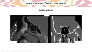 Celdillas de Onodi
VARIACIONES ANATÓMICAS: ETMOIDALES
Kennedy DW, Hwang PH. Rhinology: Diseases of the Nose, Sinuses, and Skull Base. 1a ed. Thieme Medical; 2012.
 