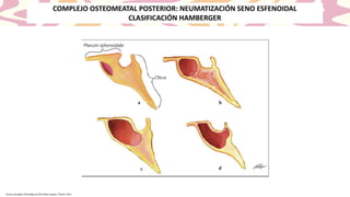 Hristos Georgalas, Rhinology and Skull Base Surgery, Thieme, 2013
COMPLEJO OSTEOMEATAL POSTERIOR: NEUMATIZACIÓN SENO ESFENOIDAL
CLASIFICACIÓN HAMBERGER
 