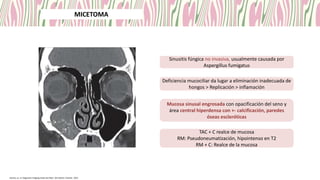 Sinusitis fúngica no invasiva, usualmente causada por
Aspergillus fumigatus
Deficiencia mucociliar da lugar a eliminación inadecuada de
hongos > Replicación > inflamación
Mucosa sinusal engrosada con opacificación del seno y
área central hiperdensa con +- calcificación, paredes
óseas escleróticas
TAC + C realce de mucosa
RM: Pseudoneumatización, hipointenso en T2
RM + C: Realce de la mucosa
Koontz, et. al. Diagnostic Imaging Head and Neck. 4th edition. Elsevier, 2022
RINOSINUSITIS CRÓNICA
MICETOMA
 