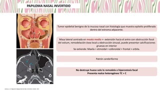 Tumor epidelial benigno de la mucosa nasal con histología que muestra epitelio proliferado
dentro del estroma adyacente.
Masa lateral centrada en meato medio +- extensión hacia el antro con obstrucción focal
del ostium, remodelación ósea local y obstrucción sinusal, puede presentar calcificaciones
gruesas en interior
Se extiende: Maxila > etmoidal > esfenoidal > frontal > orbita.
Patrón cerebriforme
No destruye hueso solo lo remodela o hiperostosis focal
Presenta realce heterogéneo TC + C
Koontz, et. al. Diagnostic Imaging Head and Neck. 4th edition. Elsevier, 2022
PAPILOMA NASAL INVERTIDO
 