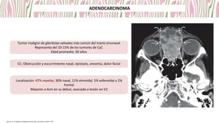 Tumor maligno de glándulas salivales más común del tracto sinunasal
Representa del 10-15% de los tumores de CyC
Edad promedio: 50 años
CC: Obstrucción y escurrimiento nasal, epistaxis, anosmia, dolor facial
Localización: 47% maxilar, 30% nasal, 11% etmoidal, 5% esfenoidal y 2%
frontal
Mayores a 4cm en su debut, asociado a lesión en V2
Koontz, et. al. Diagnostic Imaging Head and Neck. 4th edition. Elsevier, 2022
ADENOCARCINOMA
 