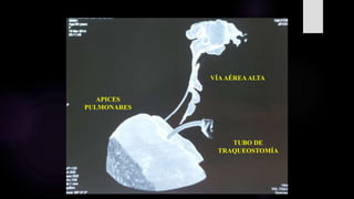VÍAAÉREAALTA
APICES
PULMONARES
TUBO DE
TRAQUEOSTOMÍA
 