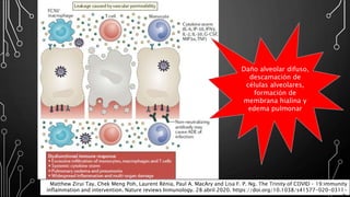 Matthew Zirui Tay, Chek Meng Poh, Laurent Rénia, Paul A. MacAry and Lisa F. P. Ng. The Trinity of COVID – 19:immunity
inflammation and intervention. Nature reviews Inmunology. 28 abril 2020. https://doi.org/10.1038/s41577-020-0311-
Daño alveolar difuso,
descamación de
células alveolares,
formación de
membrana hialina y
edema pulmonar
 