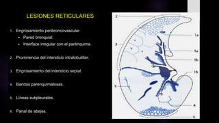 LESIONES RETICULARES
1. Engrosamiento peribroncovascular
 Pared bronquial.
 Interface irregular con el parénquima.
2. Prominencia del intersticio intralobulillar.
3. Engrosamiento del intersticio septal.
4. Bandas parenquimatosas.
5. Líneas subpleurales.
6. Panal de abejas.
 