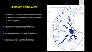 LESIONES NODULARES
1. Prominencia de estructuras centrilobulillares
a. Centrilobulillar punteado, lineal o en ramas
b. Arbol en yema
2. Nódulos intersticiales (perilinfaticos)
3. Nódulos diseminados (perivasculares)
4. Nódulos acinares centrilobulillares
 